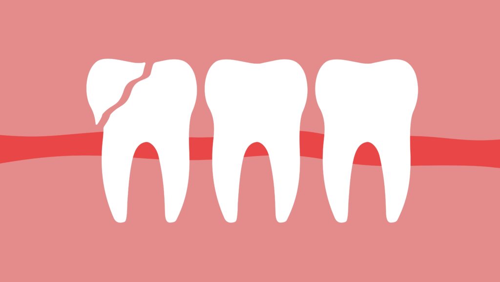 치아 사이 깨짐