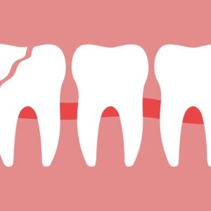 치아 사이 깨짐