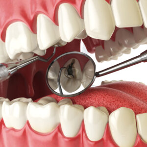 치아 구멍 충치