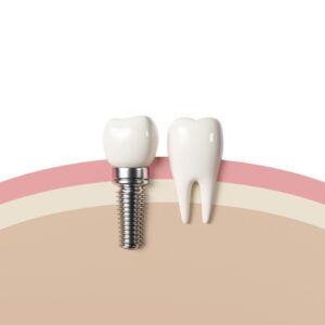 3d,Render,White,Tooth,Implant,Implant,Cut,,Healthy,Tooth,Or