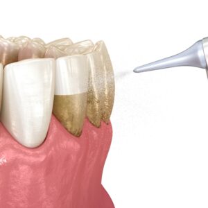 Oral,Hygiene:,Air,Flow,Water,Teeth,Cleaning.,Medically,Accurate,3d