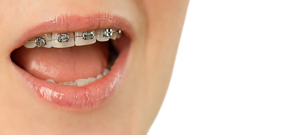 오산교정치과추천