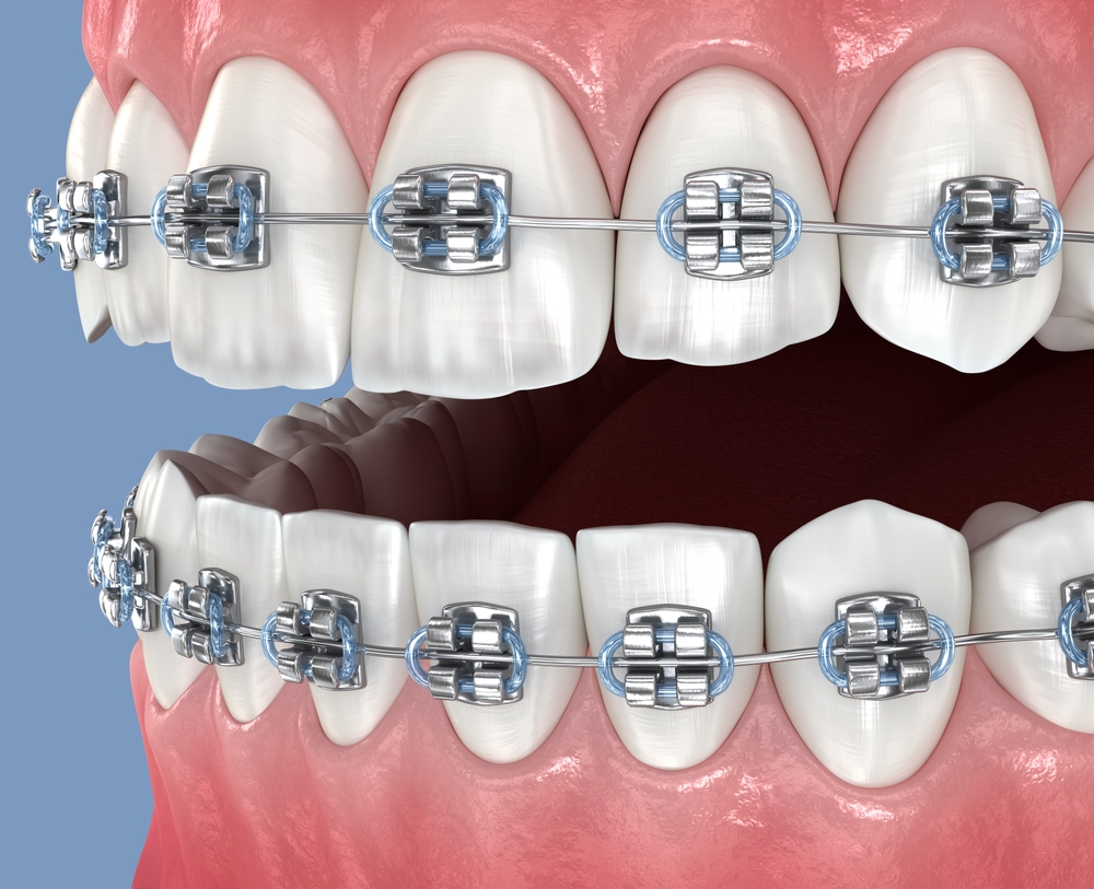 고철치아교정사진