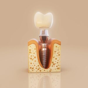 Conceptual,3d,Illustration,Of,A,Dental,Implant,Inside,The,Jawbone