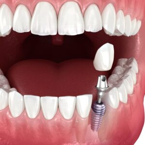 Dental,Implant,And,Ceramic,Crown.,Medically,Accurate,Tooth,3d,Illustration.