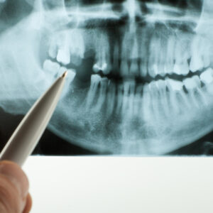 Panoramic,Dental,X-ray,,All,Teeth,In,View