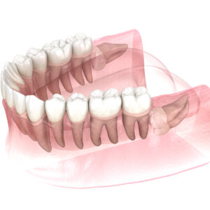 Horizontal,Impaction,Of,Wisdom,Tooth.,Medically,Accurate,Tooth,3d,Illustration