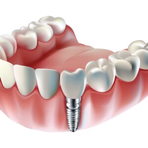 Tooth,Implant,,Tooth,Restoration,,On,White,Background,,Vector,Illustration